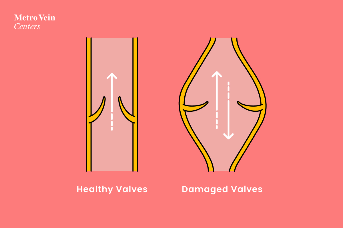 Illustration showing the difference between healthy and damaged veins