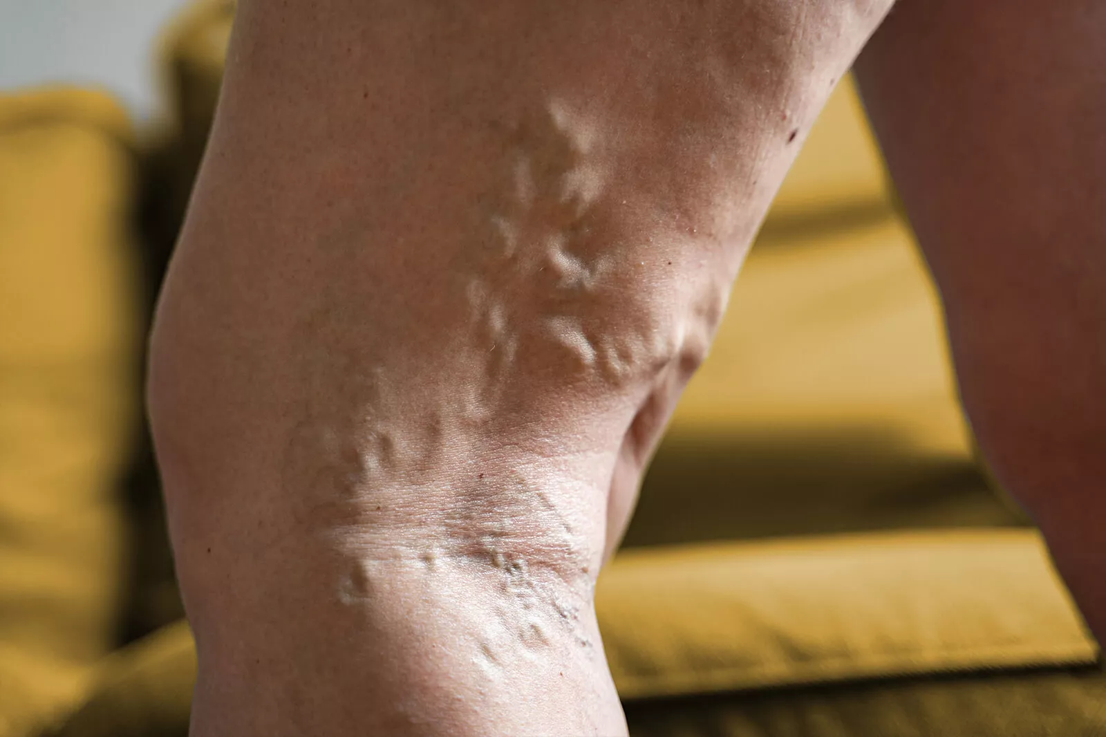 Delve into how genetic predispositions contribute to venous diseases like varicose veins and deep vein thrombosis, and understand the implications for diagnosis and treatment.