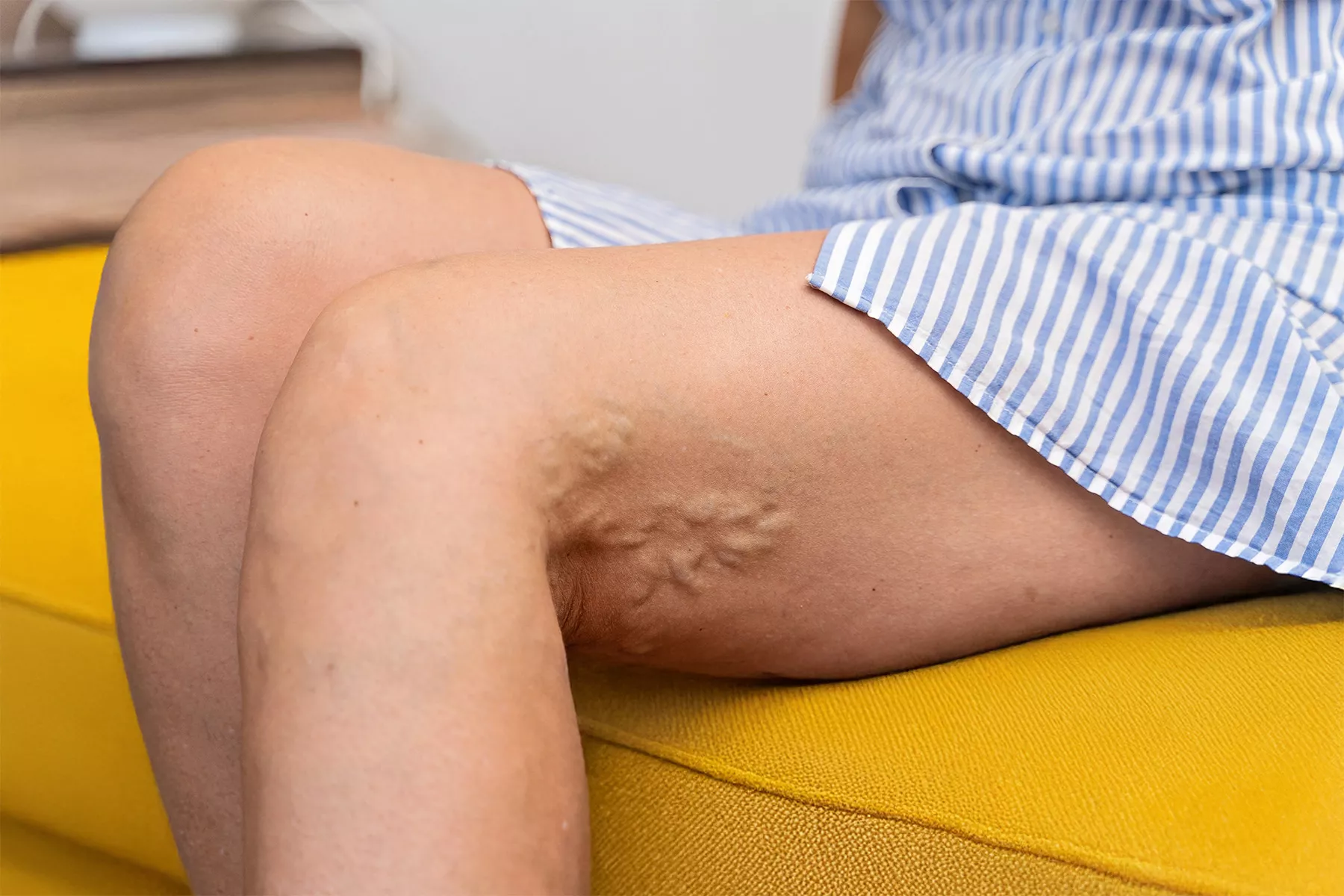 Learn about the physical, emotional, and social effects varicose veins have on daily life. Discover practical strategies to manage symptoms and improve quality of life.