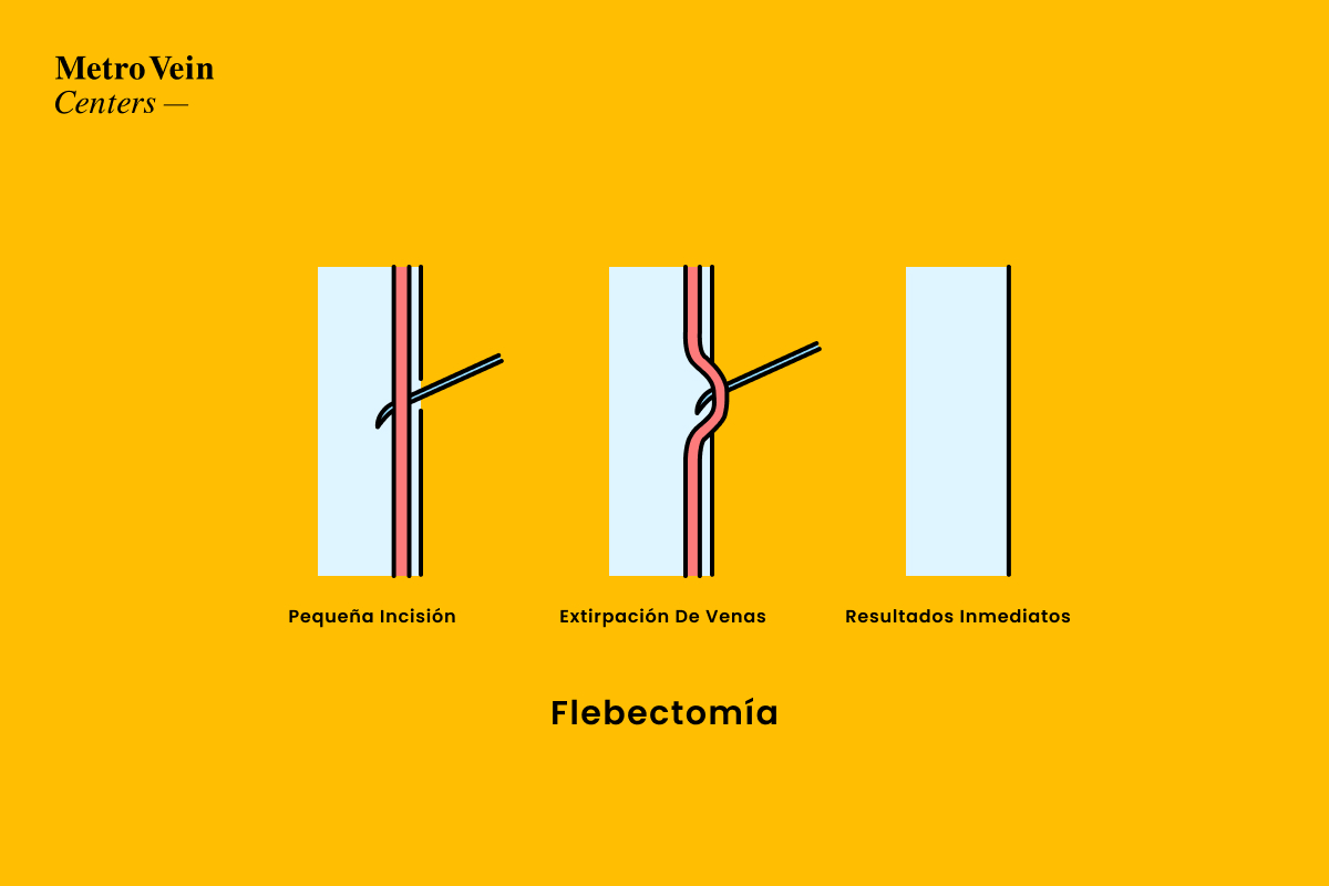 How phlebectomy treatment works www.metroveincenters.com