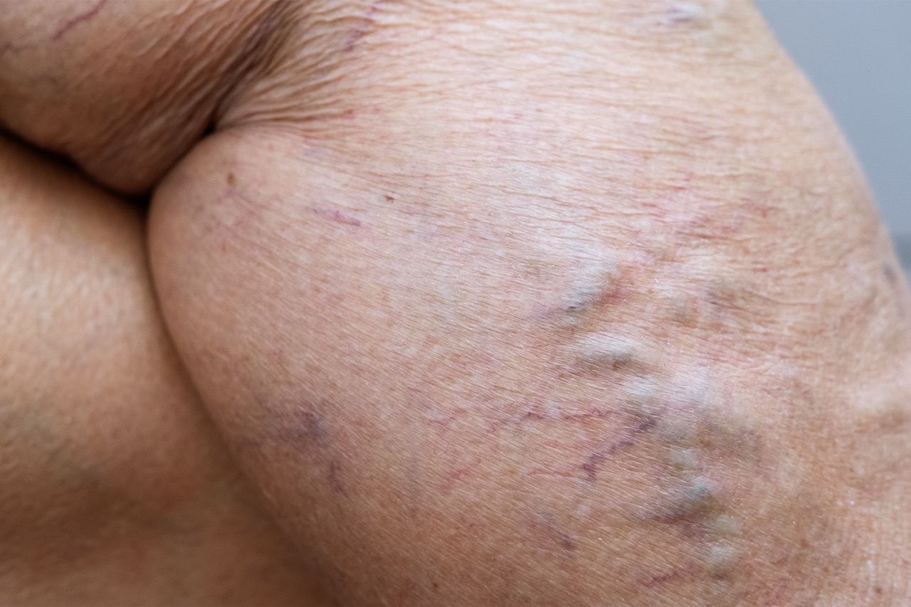 Aprende c&oacute;mo la humedad afecta la salud de las venas y descubre estrategias pr&aacute;cticas para prevenir la hinchaz&oacute;n, reducir las molestias y mantener una circulaci&oacute;n saludable en ambientes c&aacute;lidos y h&uacute;medos.