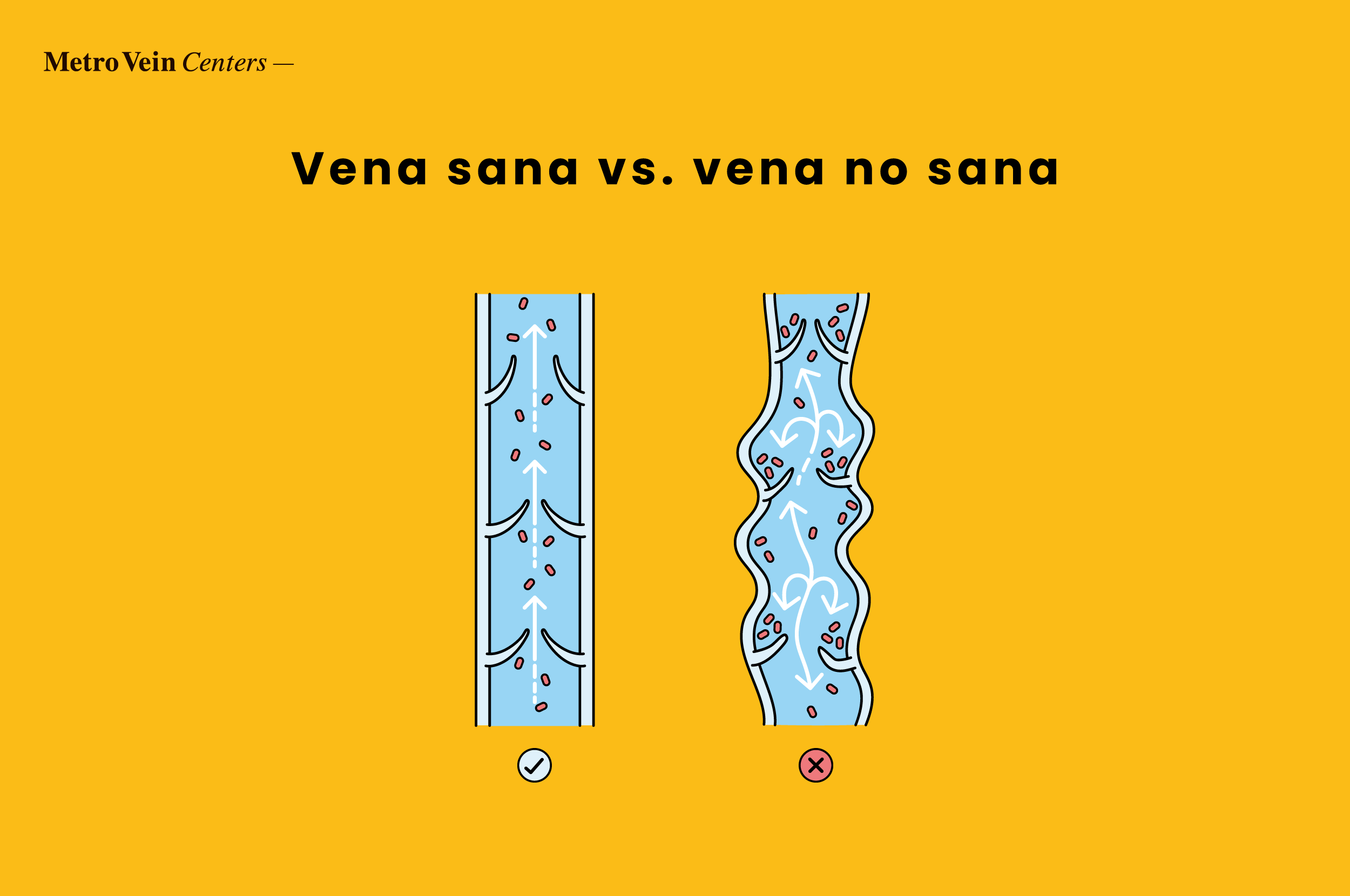 Conozca la enfermedad por reflujo venoso: causas, s&iacute;ntomas y opciones de tratamiento. Controle esta afecci&oacute;n y disfrute de piernas sanas y sin dolor.